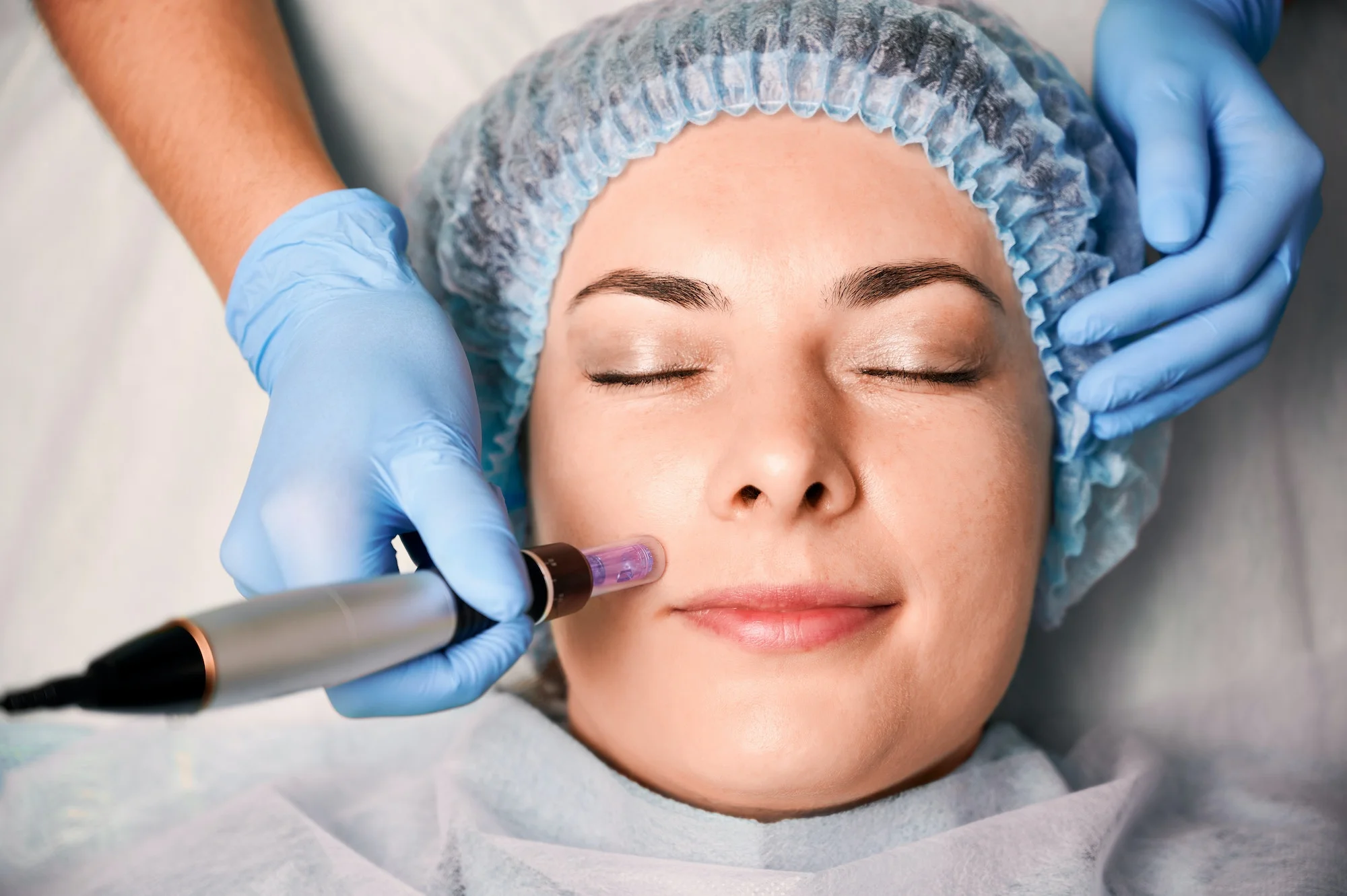 Microneedling